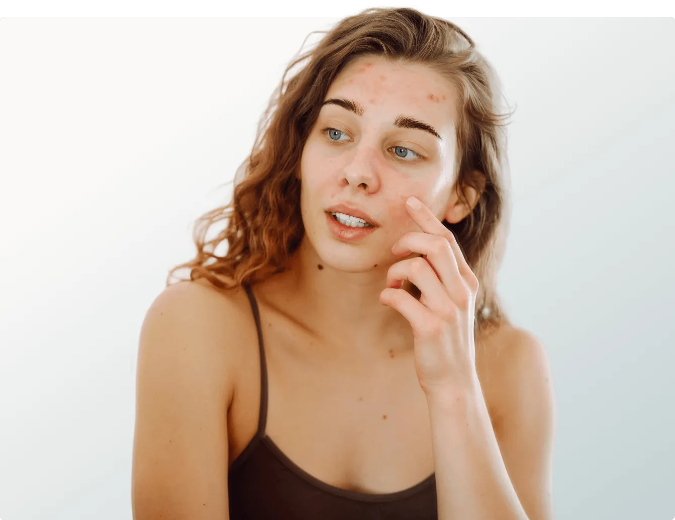 Acne treatments