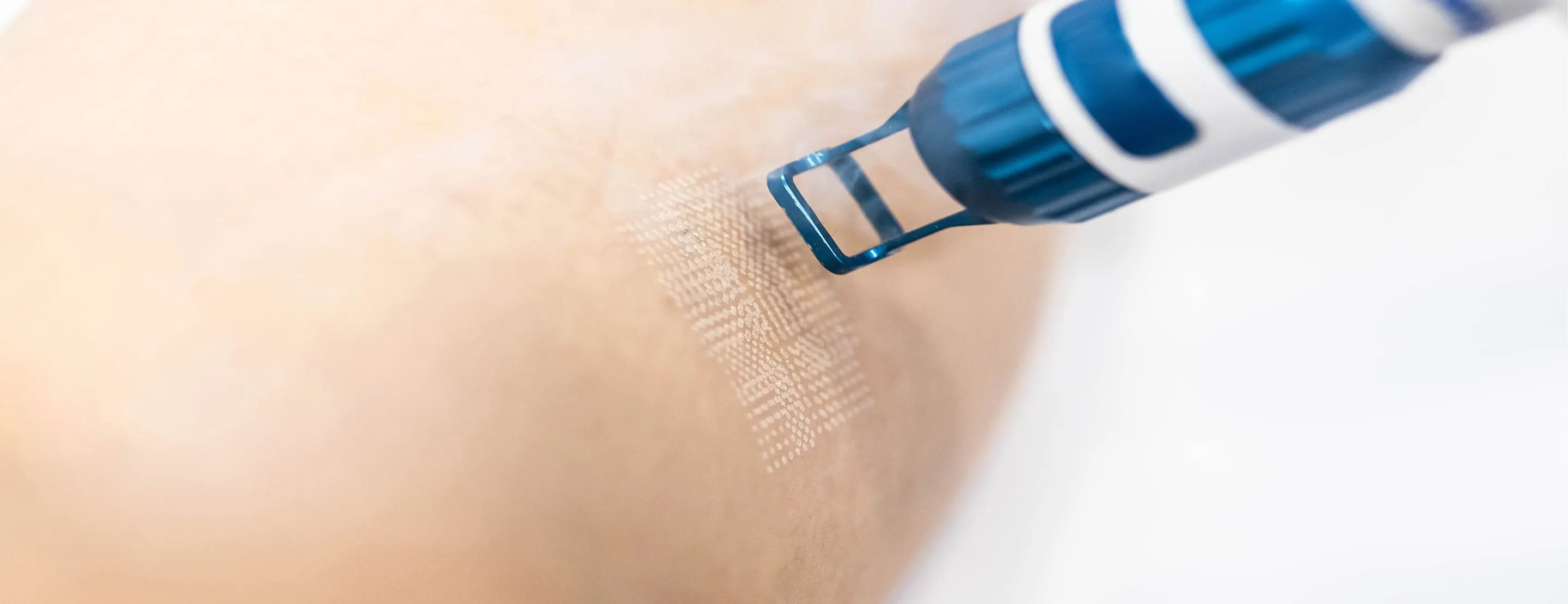 Benefits of UltraClear® Laser Treatments for Skin Rejuvenation