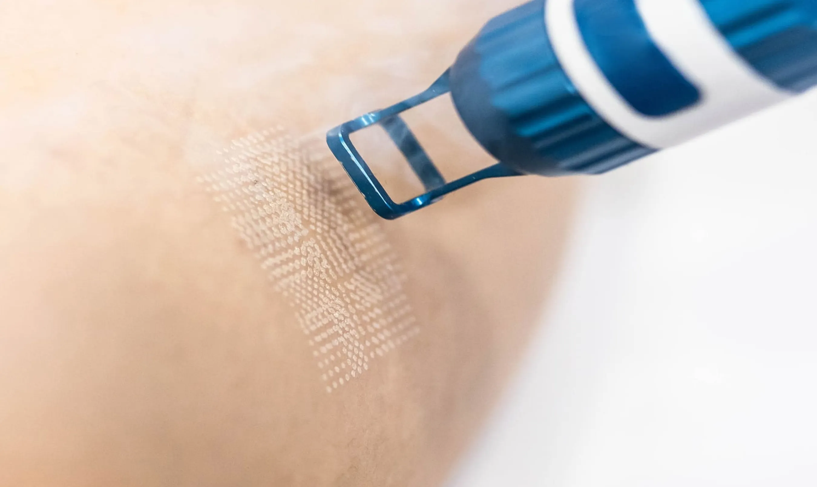 Benefits of UltraClear® Laser Treatments for Skin Rejuvenation
