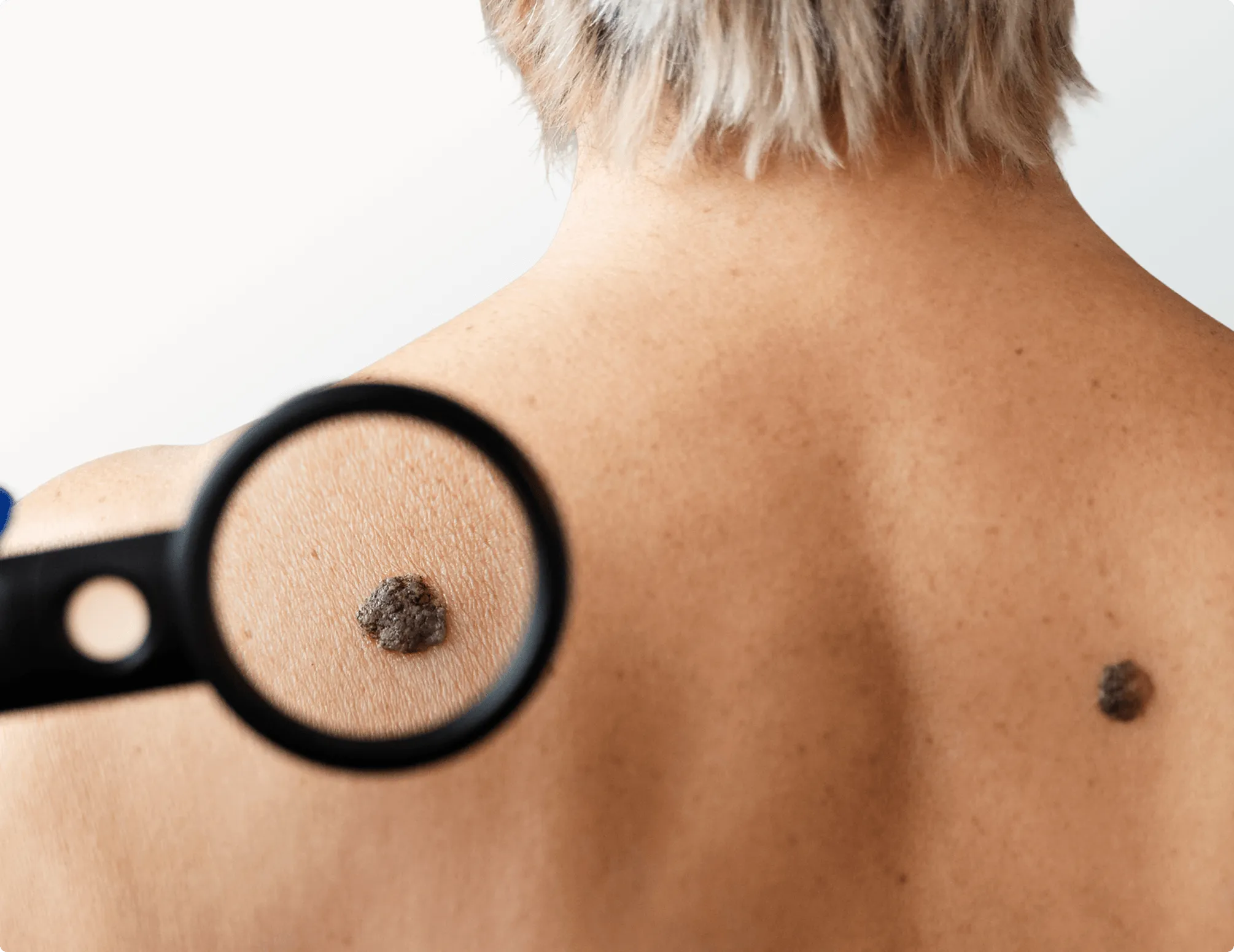 Moles and Unwanted Lesions