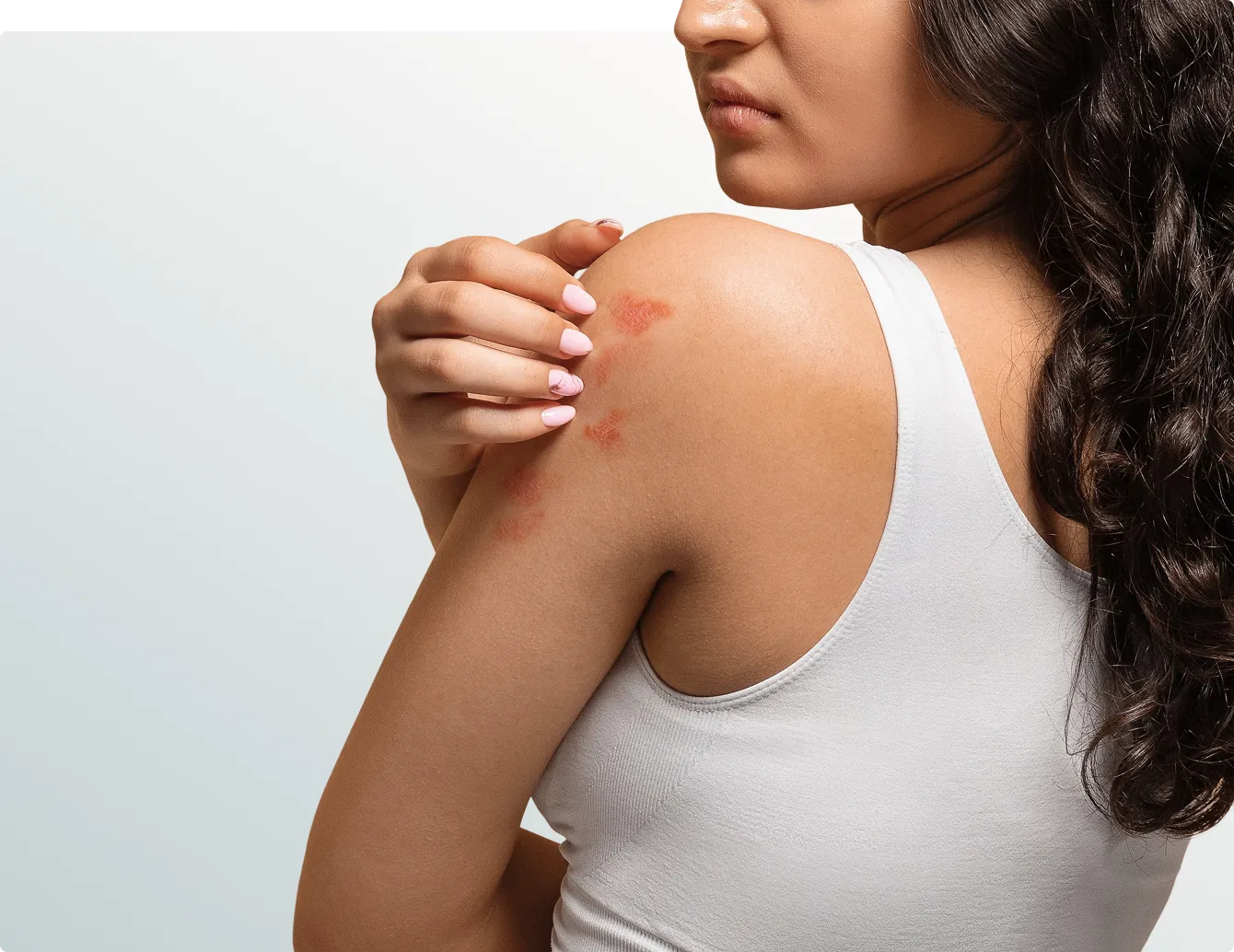 Rashes