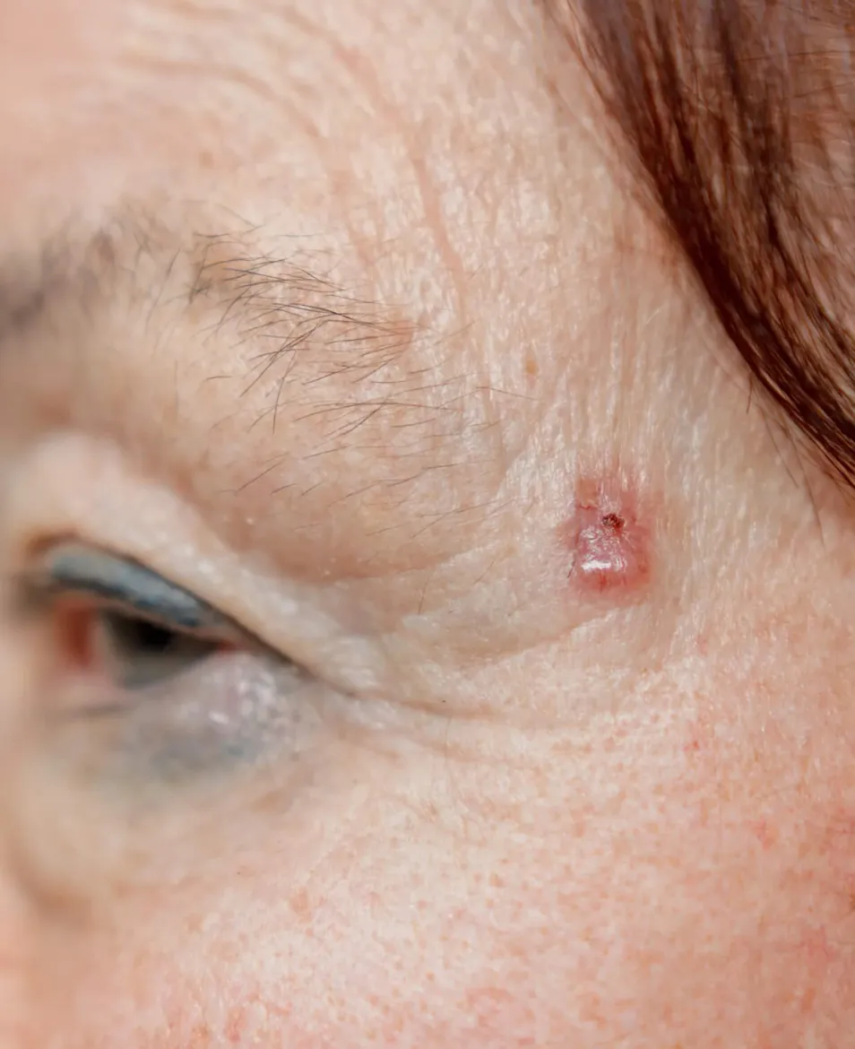 Skin surgery